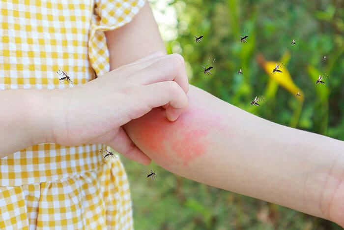 criança com picadas de mosquitos no braço.